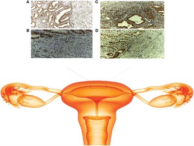 The role of the junctional zone in the management of adenomyosis with infertility